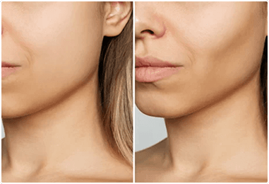 Cheek Augmentation